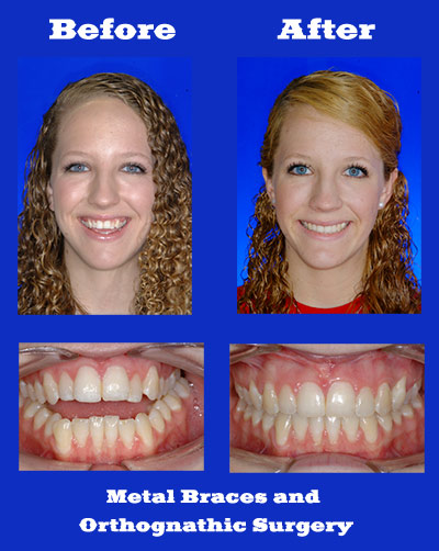 surgical orthodontics